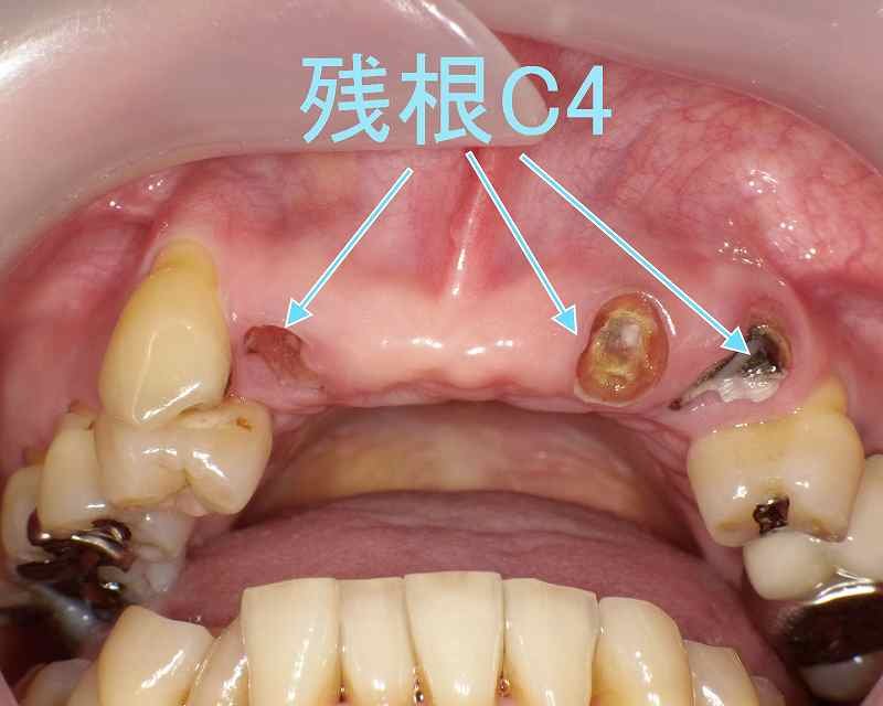 抜歯後いつインプラントができる?治療時期と注意点を解説 ニュース画像1