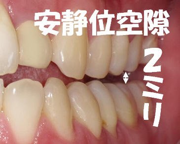 安静空隙の正常値と意義：食いしばり・顎関節症との関連 ニュース画像1