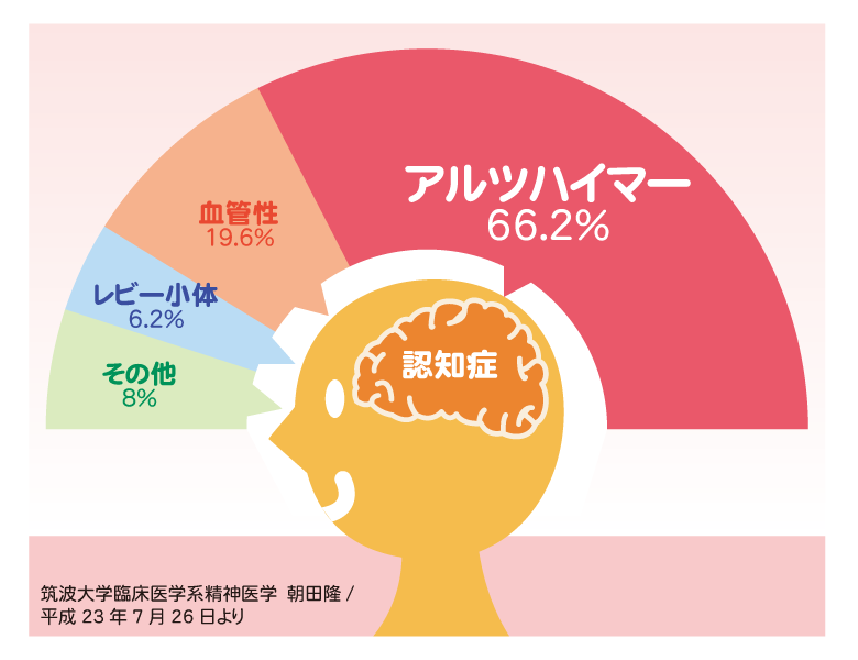 歯周病とアルツハイマー型認知症:最新研究の口腔−脳連関 ニュース画像1