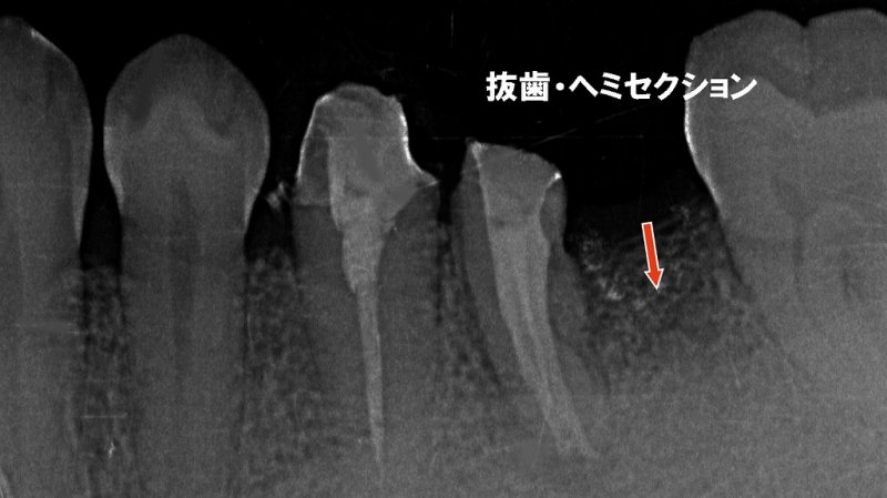 ヘミセクションとは?歯を部分的に残すための保存外科治療 ニュース画像1