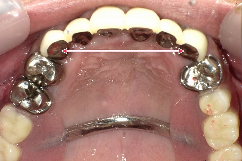 ブリッジ治療とは?メリット・デメリットを歯科医が解説 ニュース画像1