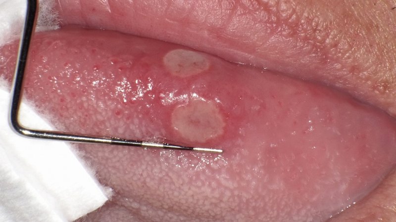 口内炎の原因と正しい対処法|種類別の特徴と治療の流れ ニュース画像1