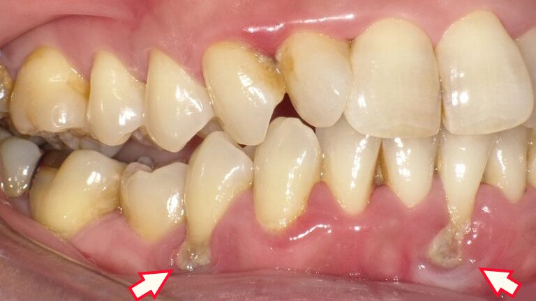 歯周病は“沈黙の病気” 手遅れになる前のサインと治療法 ニュース画像1