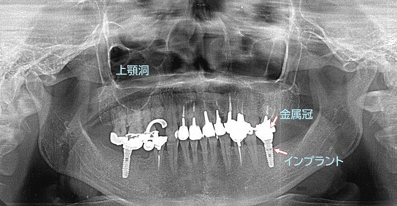 歯科レントゲンは本当に必要?種類・役割・安全性を解説 ニュース画像1