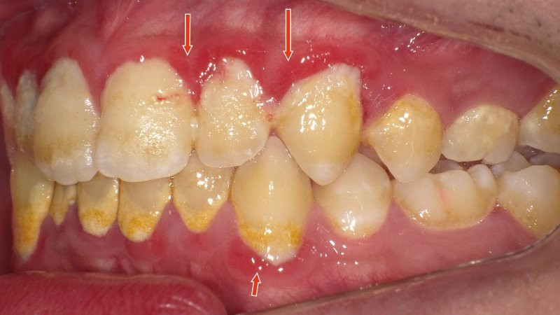 歯磨き時の出血は要注意：放置すると進行する歯周病の実態 ニュース画像1