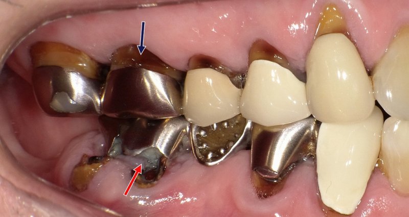 根面う蝕とは?高齢者に多い“見逃しやすい虫歯”の予防法 ニュース画像1