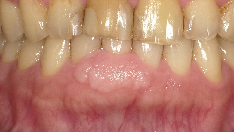 エプーリス(良性歯肉腫瘤)の理解|原因・症状・治療法 ニュース画像1