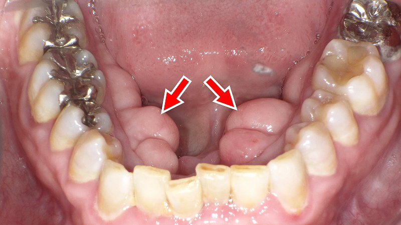 歯ぐきの内側に硬いコブ?下顎隆起(外骨症)の正体とは ニュース画像1