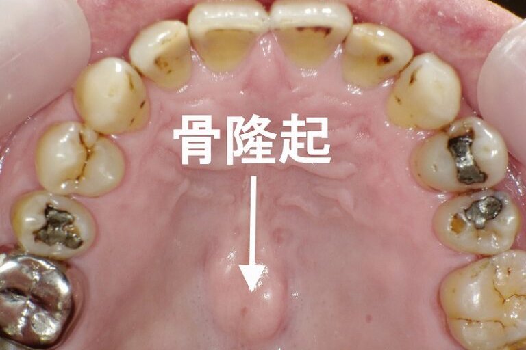 口蓋隆起とは？原因・特徴・治療が必要なケースを解説 ニュース画像1