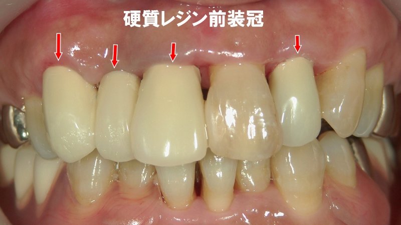 硬質レジン前装冠とは?保険で白い前歯を回復する治療法 ニュース画像1