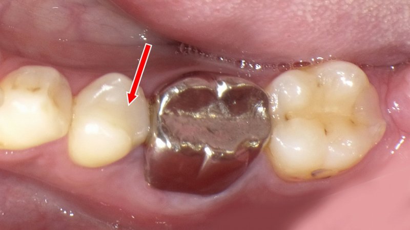 CAD/CAMインレー?保険の白い詰め物の特徴と注意点 ニュース画像1