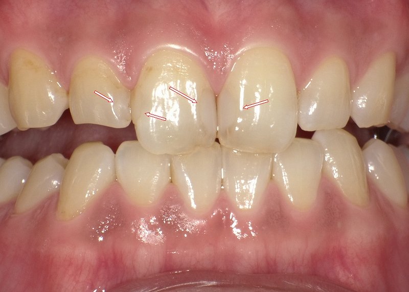 コンポジットレジン治療の基礎知識｜適応・寿命・再治療 ニュース画像1