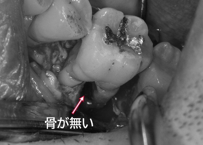 大臼歯に起こる根分岐部病変｜原因・進行度・治療の限界は ニュース画像1