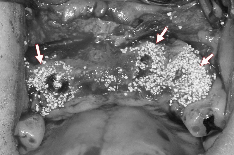 抜歯即時インプラントの利点・欠点｜向く人・向かない人 ニュース画像1