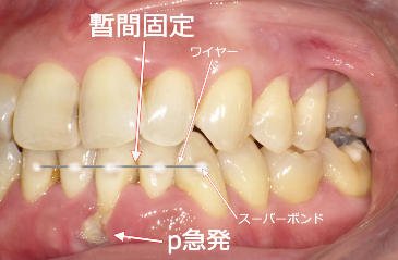 動揺歯を一時的に安定させる暫間固定の目的と治療プロセス ニュース画像1