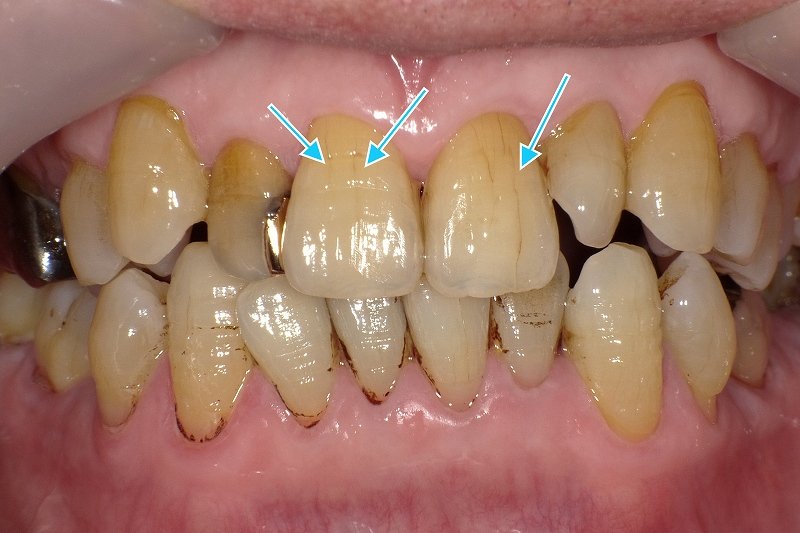 歯に入ったヒビは放置していい?進行度別の診断と治療 ニュース画像1