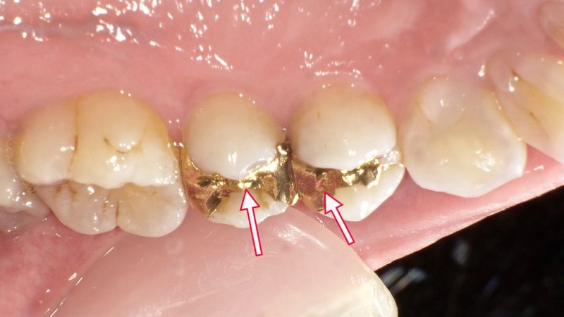 インレー治療のすべて｜詰め物の種類・保険と自費・寿命 ニュース画像1