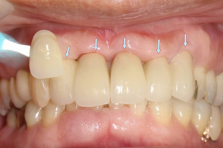 メタルボンドとは？構造・特徴・適応を歯科医が解説 ニュース画像1