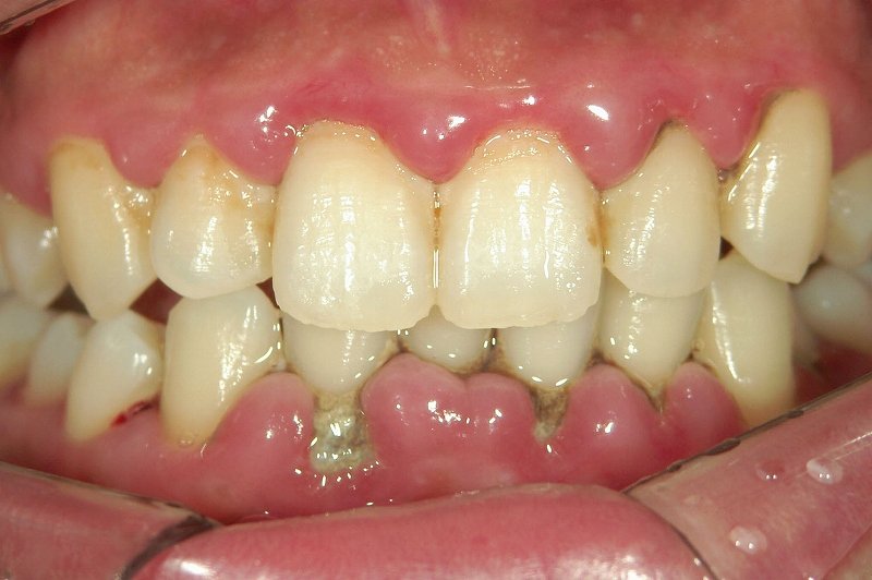 歯石とは？放置するとどうなる？口臭・歯周病・全身リスク ニュース画像1