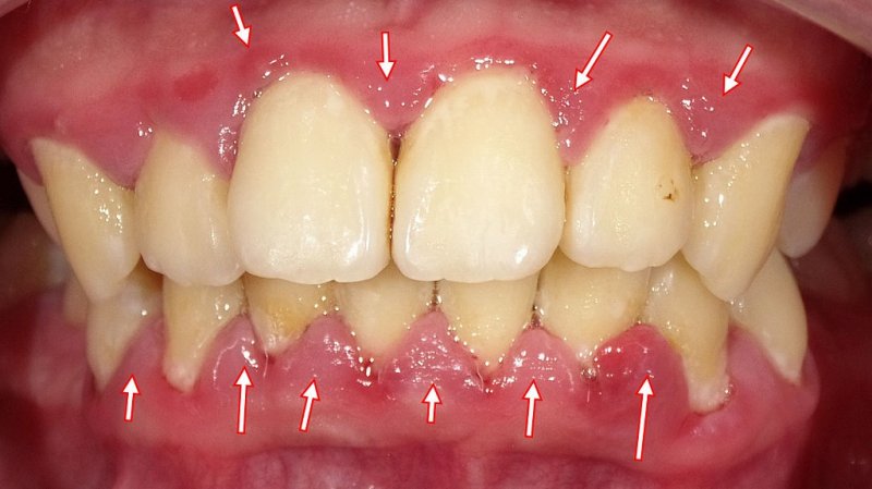 歯茎出血の原因とは|歯周病だけではない注意すべきサイン ニュース画像1