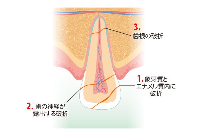 歯が欠ける原因と対処法|虫歯・歯ぎしり・外傷まで解説 ニュース画像1