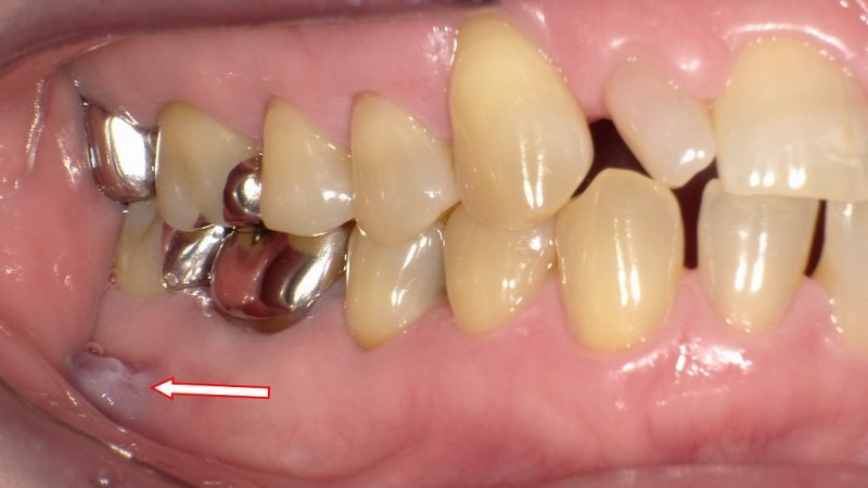 突然歯茎が腫れたときに考えるべき原因と正しい対処法 ニュース画像1