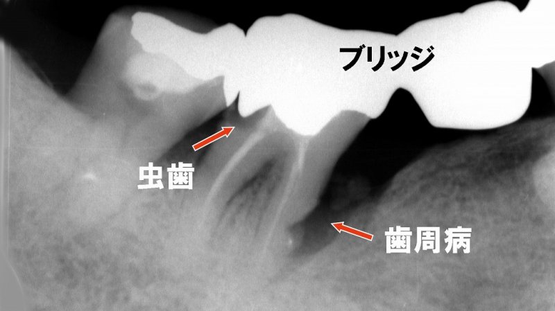 歯のブリッジで後悔しない|メリット・デメリットと選び方 ニュース画像1
