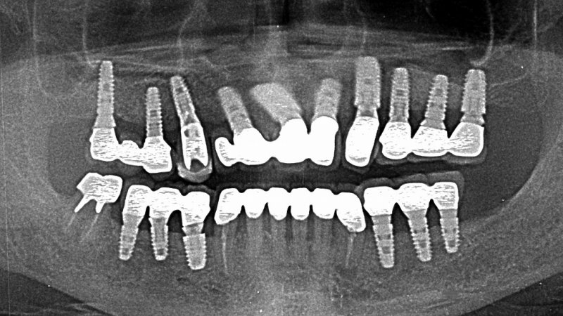 難症例インプラントとは？一般的な治療との違いと対応法 ニュース画像1