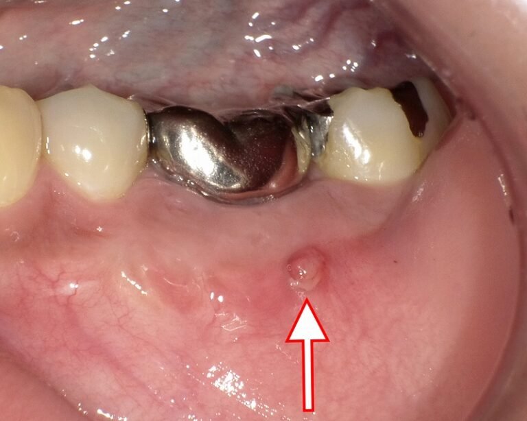 什么是瘘管?瘘管是脓液无痛但危险的排出途径。新闻图片 1