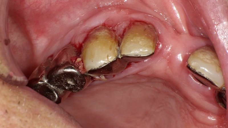 オーラルフレイルとは?口腔機能低下が全身の健康に影響 ニュース画像1