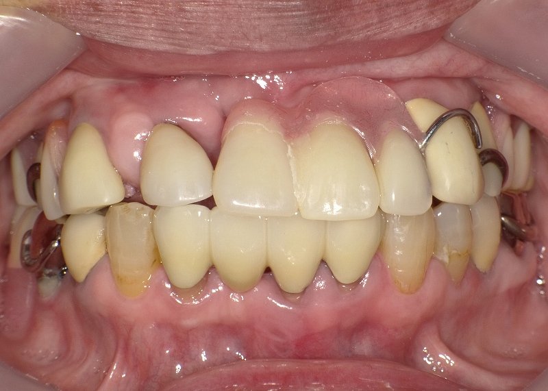 部分入れ歯はどこまで目立たなくできる?保険と自費の違い ニュース画像1