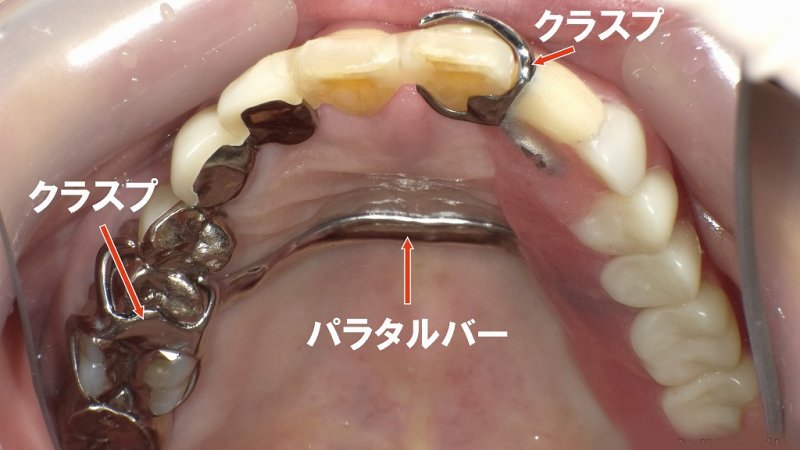 入れ歯は何歳から必要?年代別の使用率と選び方 ニュース画像1