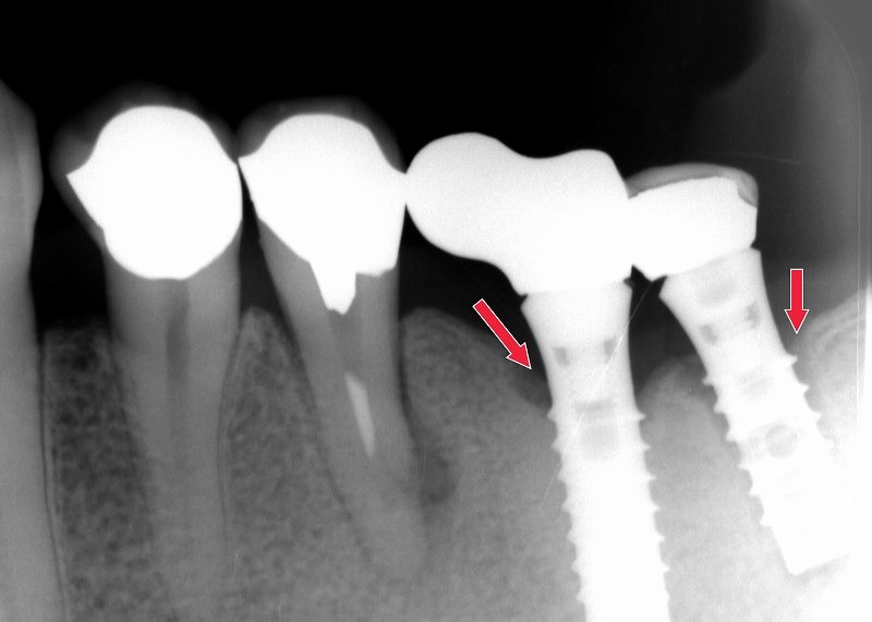 インプラント周囲炎の原因・症状・進行リスクと予防法 ニュース画像1