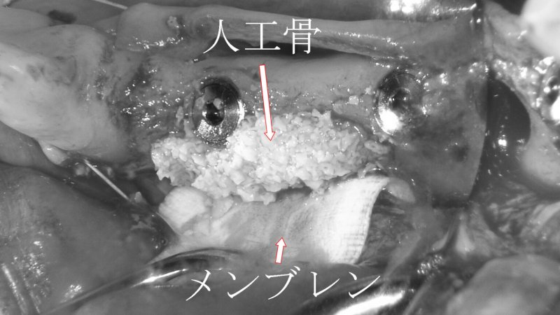 GBR(骨造成)とは?インプラント成功率を高める骨再生 ニュース画像2