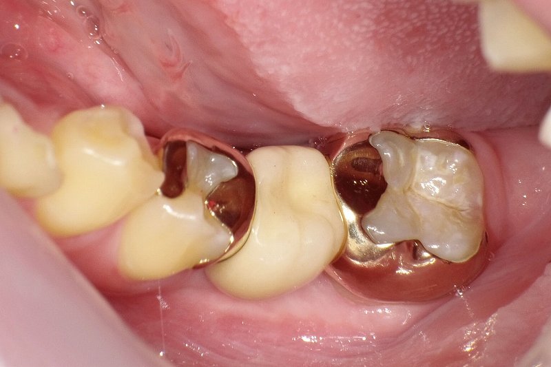 ヒューマンブリッジとは？削除量を最小限に抑えるブリッジ ニュース画像1