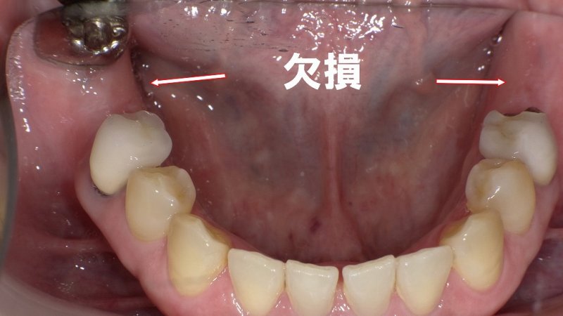 ノンクラスプデンチャーとは?目立たない部分入れ歯の特徴 ニュース画像1