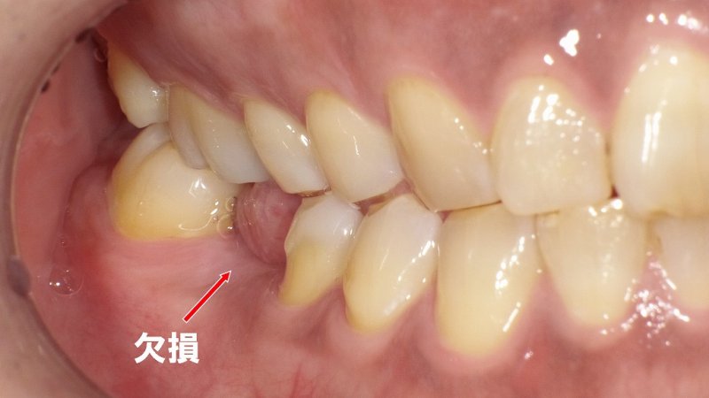 失った歯の治療はどっち？ブリッジとインプラントの選び方 ニュース画像1