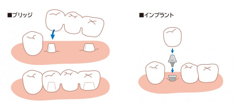 失った歯の治療はどっち?ブリッジとインプラントの選び方 ニュース画像2