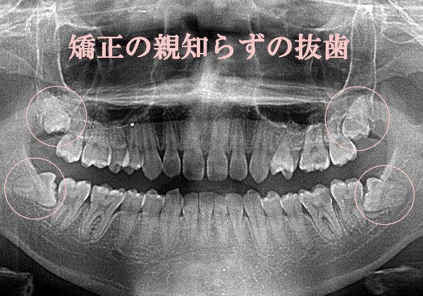 矯正治療と親知らずの関係|抜歯が必要な理由と判断基準 ニュース画像1