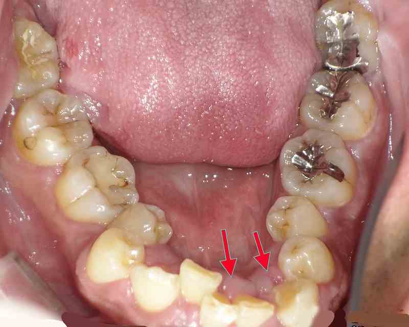 歯周病があっても矯正は可能？治療の条件と進め方を解説 ニュース画像1