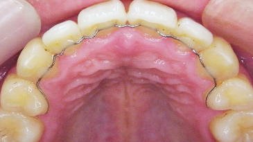 矯正後の歯並びを守る「リテーナー」とは？役割と必要性 ニュース画像1