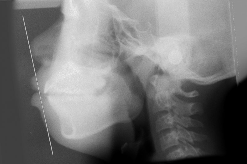 非抜歯矯正とは?ゴリラ顔になると言われる理由と治療適応 ニュース画像2