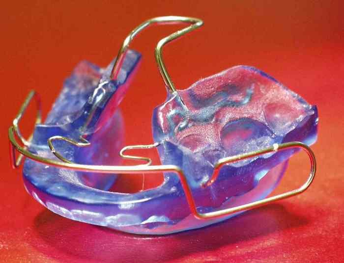 バイオネーターとは?成長期の出っ歯改善に用いる矯正装置 ニュース画像1