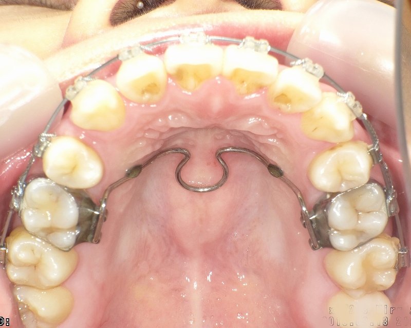 トランスパラタルアーチ（TPA）の機能・適応・注意点 ニュース画像1