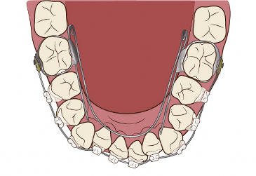 リンガルアーチとは?仕組み・適応・メリットまで解説 ニュース画像1
