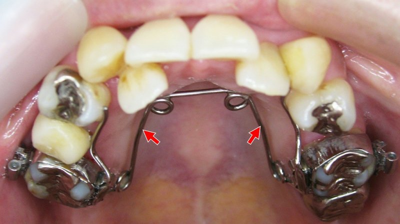 クワドヘリックスとは?効果・適応症・費用を歯科医が解説 ニュース画像1