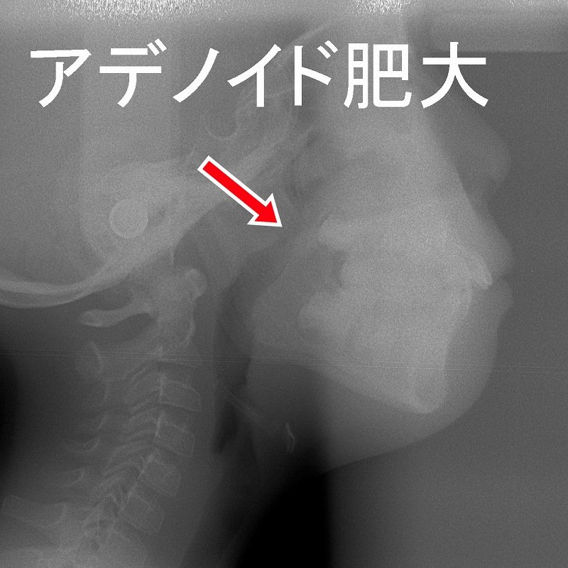 アデノイド肥大と歯科的影響―口呼吸・顎発育との関連 ニュース画像1