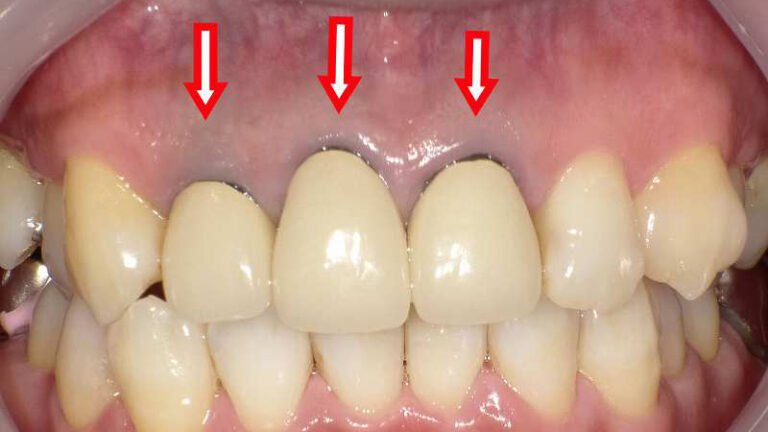 メタルタトゥーの原因・見分け方・治療法を徹底解説 ニュース画像1