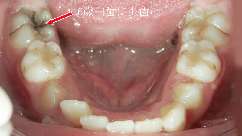 6歳臼歯の重要性と守り方｜最初の永久歯が歯並びを決める ニュース画像1