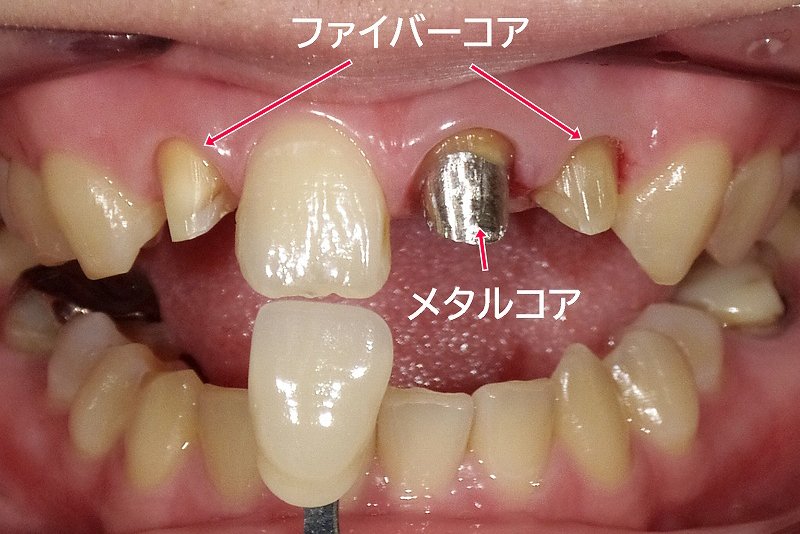 メタルコアとは？歯の寿命を左右する土台の特徴とリスク ニュース画像1